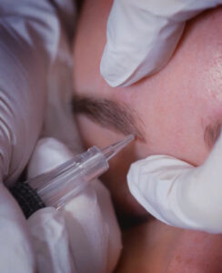 close up of saline tattoo removal process being done on an eyebrow.
