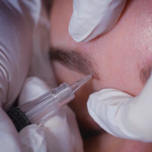 close up of saline tattoo removal process being done on an eyebrow.